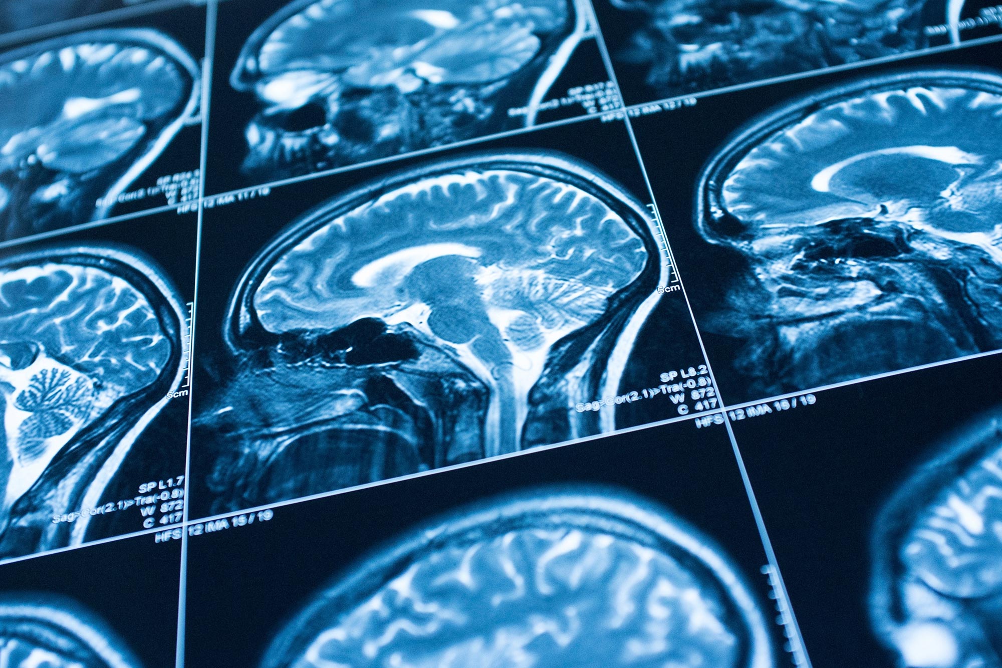 Uudessa tutkimuksessa todetaan, että anoreksialla olevilla ihmisillä on pienempi aivot